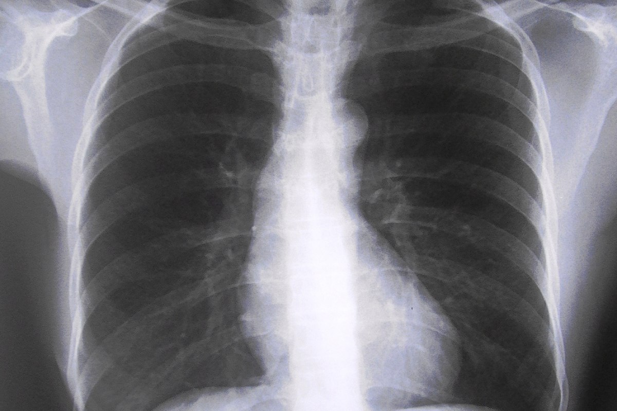 Radiografía de pulmones.